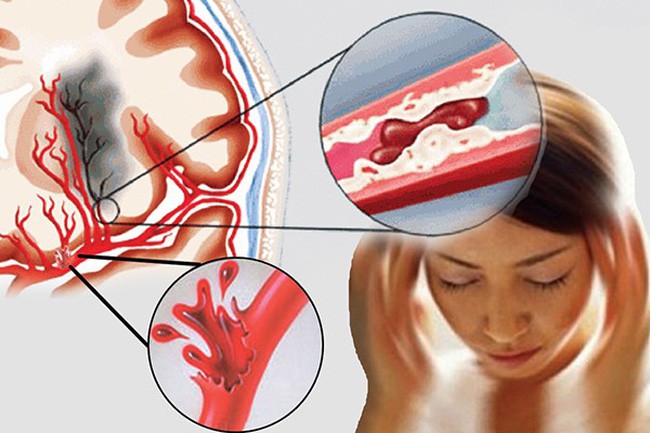 Triệu chứng của cục máu đông tong não